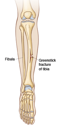 greenstick fracture humerus